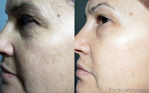 antes y despues tratamiento kit sos cosmetics27 antes y despues tratamiento kit sos cosmetics27