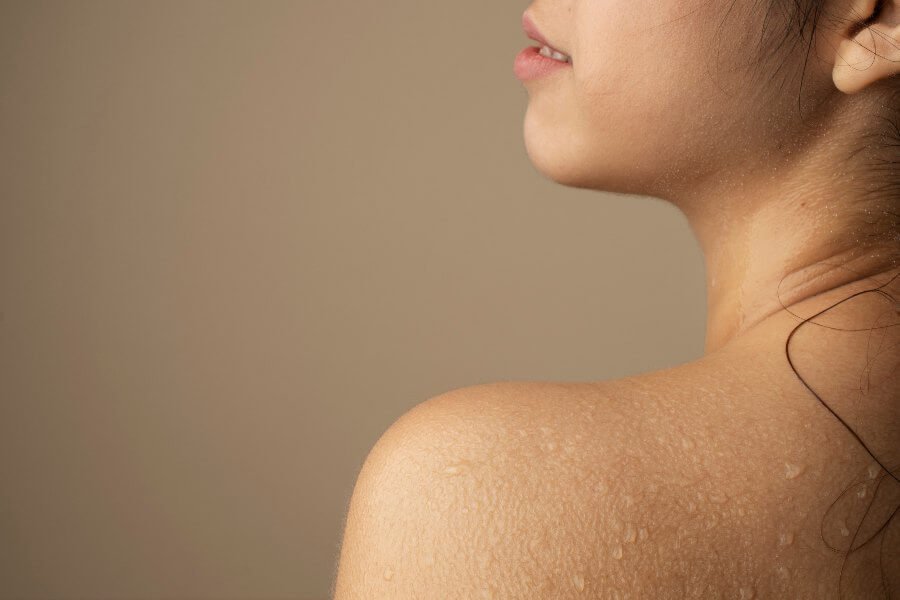 acne corporal